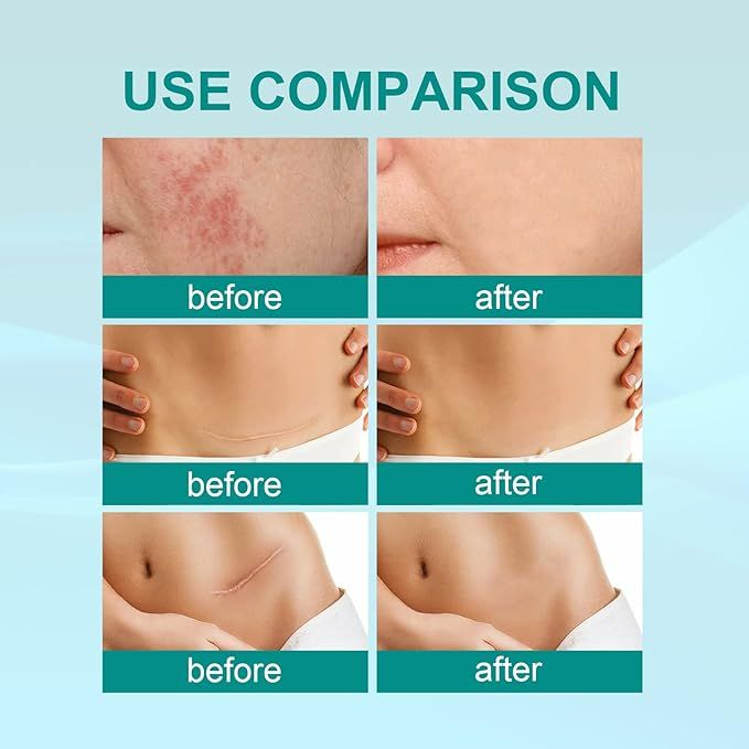 Medical Scar Care Removal Spray